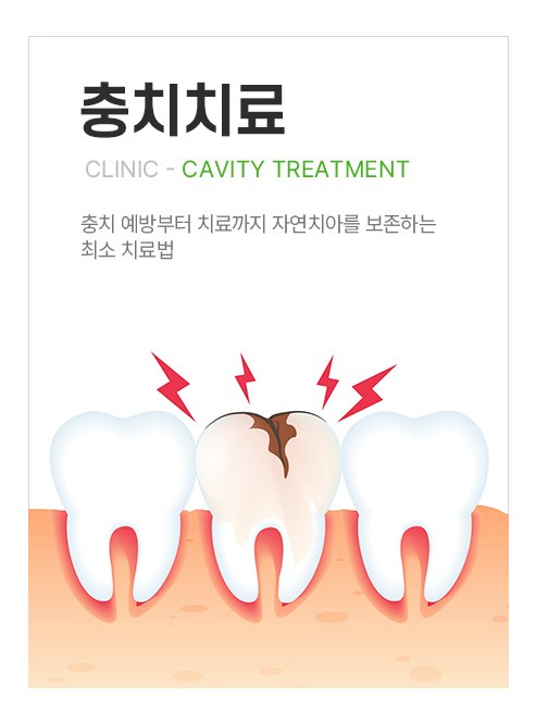 충치치료